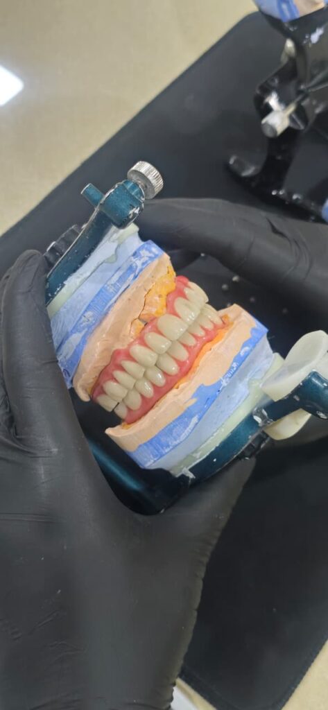 DMLS TITANUIM BREDENT HIPC HYBRID DENTURE