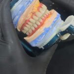 DMLS TITANUIM BREDENT HIPC HYBRID DENTURE