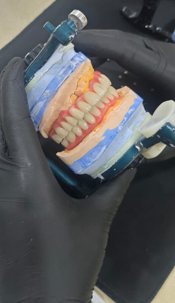 DMLS TITANUIM BREDENT HIPC HYBRID DENTURE