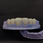 LITHIUM DI-SILICATE EMAX RESTRORATION