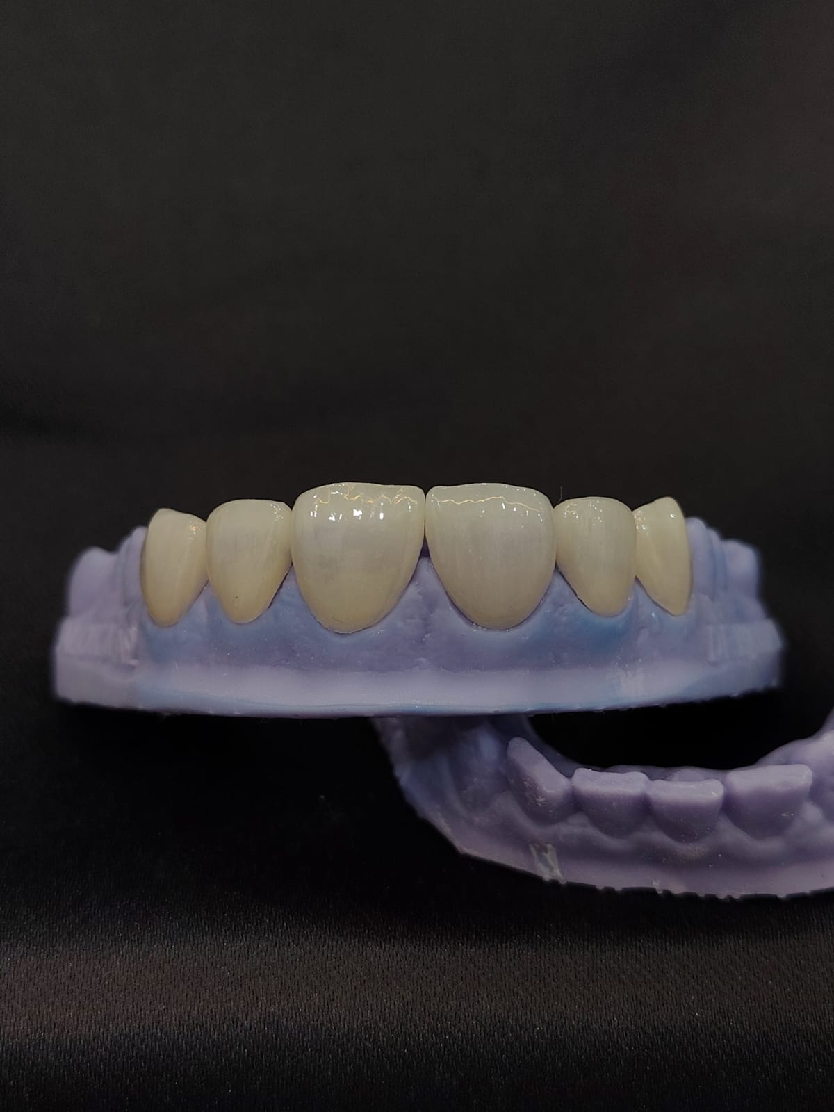 LITHIUM DI-SILICATE EMAX RESTRORATION