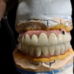IMPLANT PROSTHETIS WITH PALO MALO