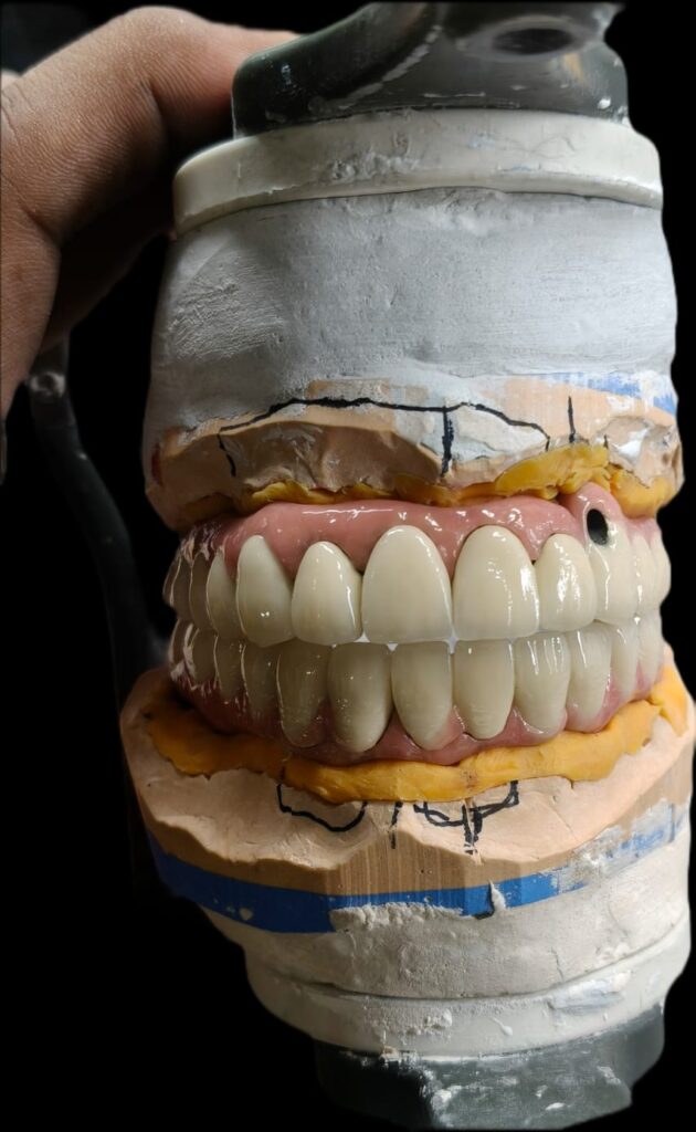 IMPLANT PROSTHETIS WITH PALO MALO