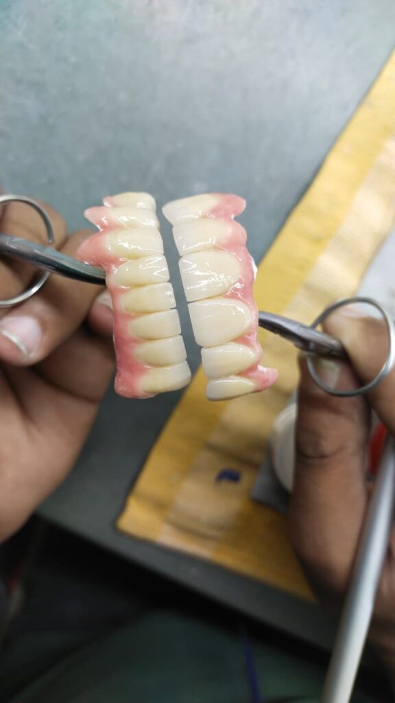 IMPLANT PROSTHETIS (CASTED)