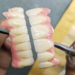 IMPLANT PROSTHETIS (CASTED)