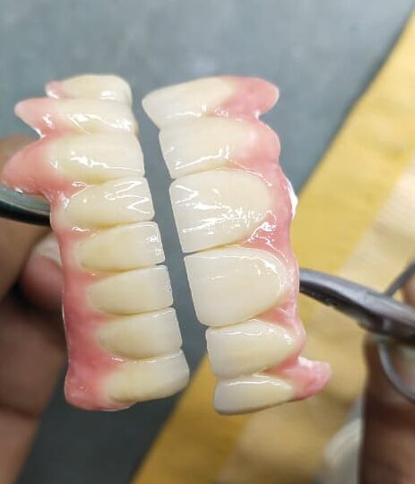 IMPLANT PROSTHETIS (CASTED)