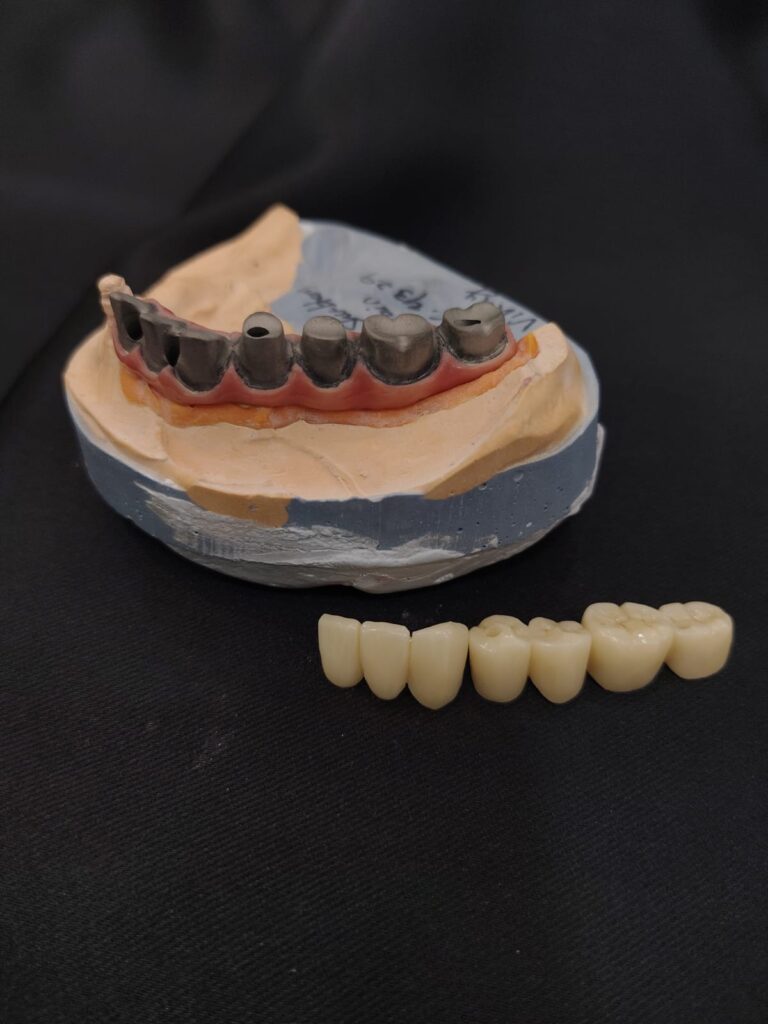 DMLS TITANUIM PALO MALO BAR WITH ZIRCONIA