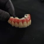DMLS CO-CR BREDENT HIPC HYBRID DENTURE